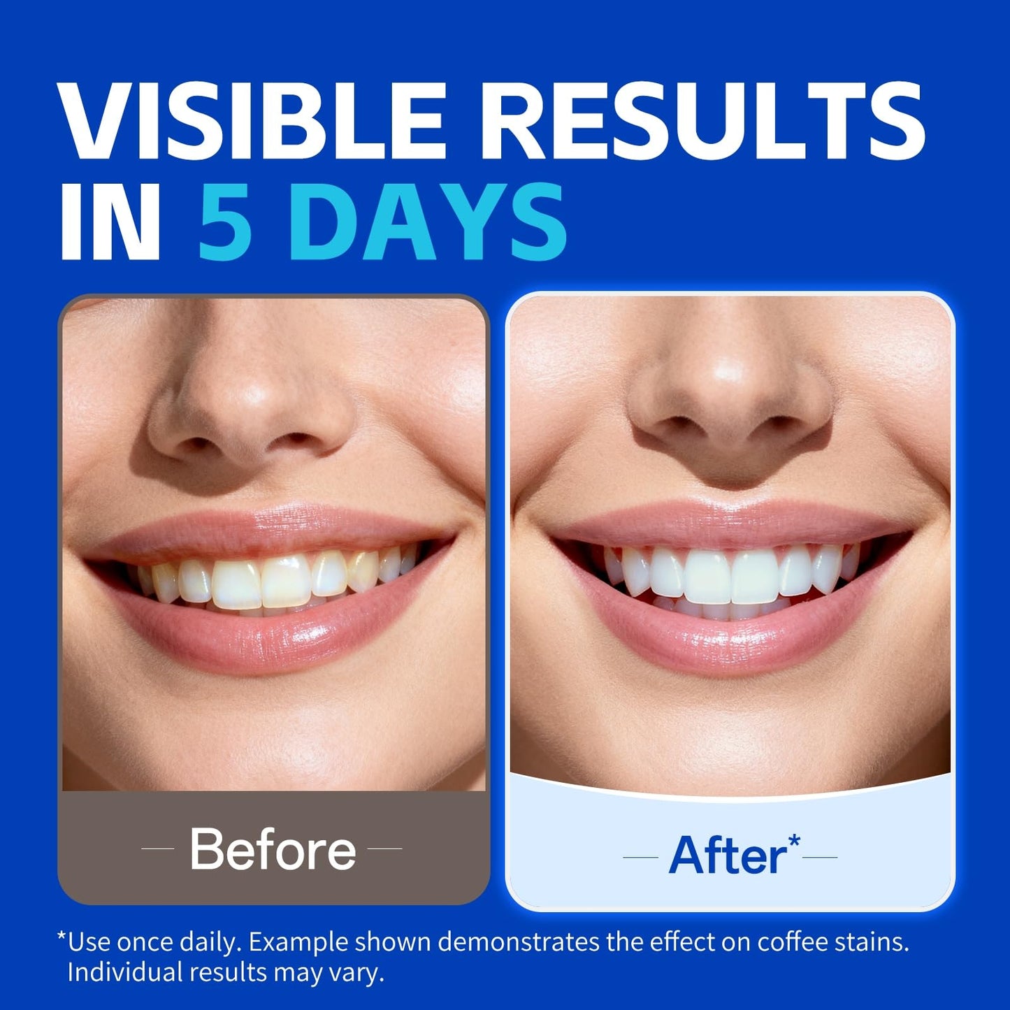 PERSMAX Teeth Whitening Strips Before and After Results Showing Brighter Smile in 5 Days