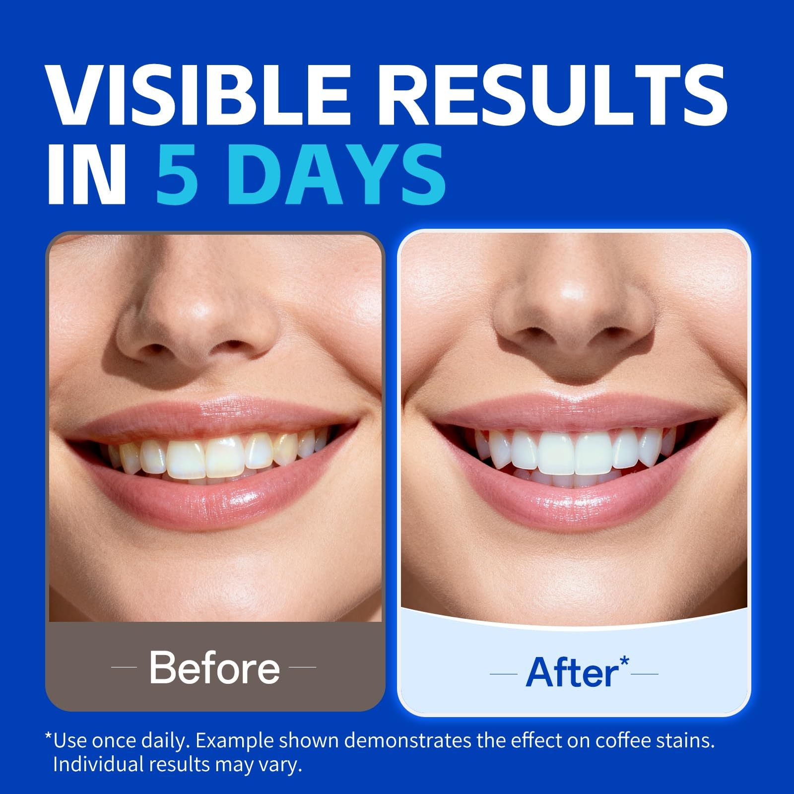 PERSMAX Teeth Whitening Strips Before and After Results Showing Brighter Smile in 5 Days