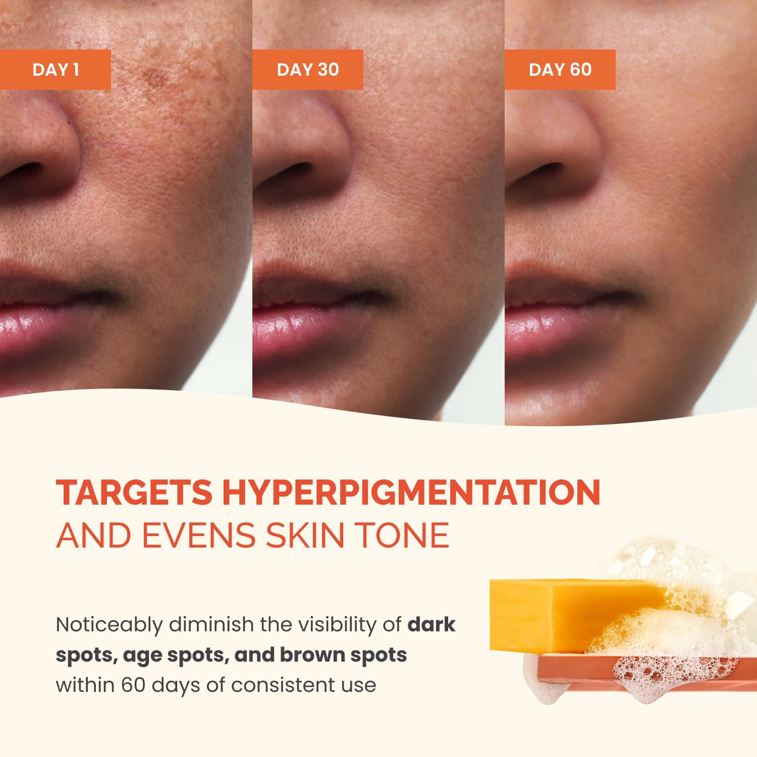 Before and after skin treatment showing hyperpigmentation reduction over 60 days with Plantifique Turmeric & Kojic Acid Soap.